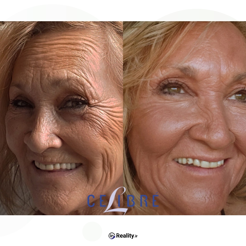 عکس قبل و بعد لیزر درمانی برای رفع چروک