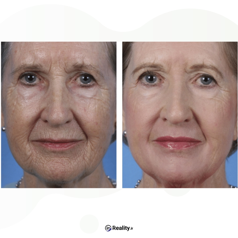 عکس قبل و بعد لیزر درمانی برای رفع چروک