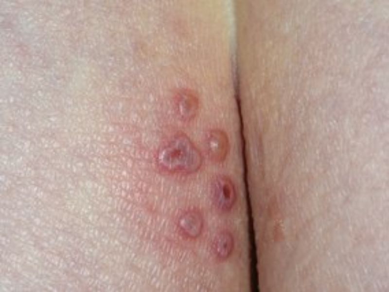 آیا تبخال مقعدی خطرناک است؟