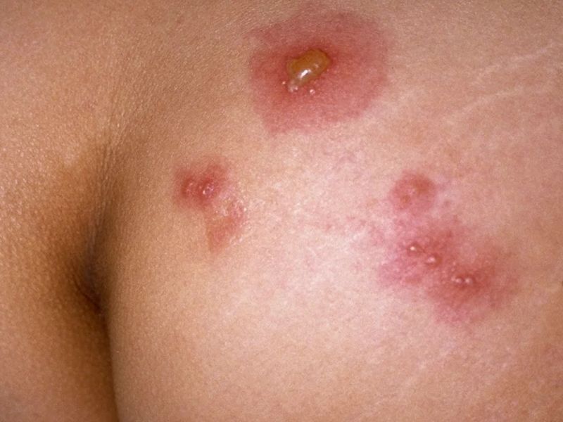 تبخال مقعدی نشانه چیست؟