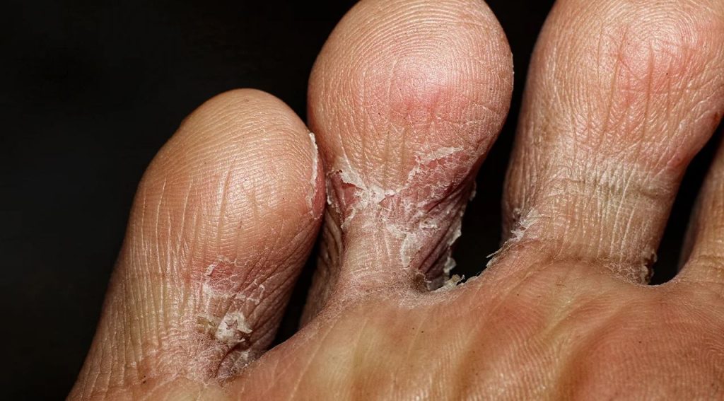 بیماری پای ورزشکار و خارش پوستی